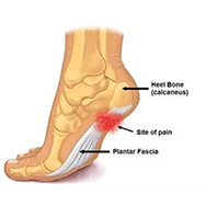 A foot that is experiencing significant pain in the bottom of the foot, signalling that there might be plantar fasciitis. 
